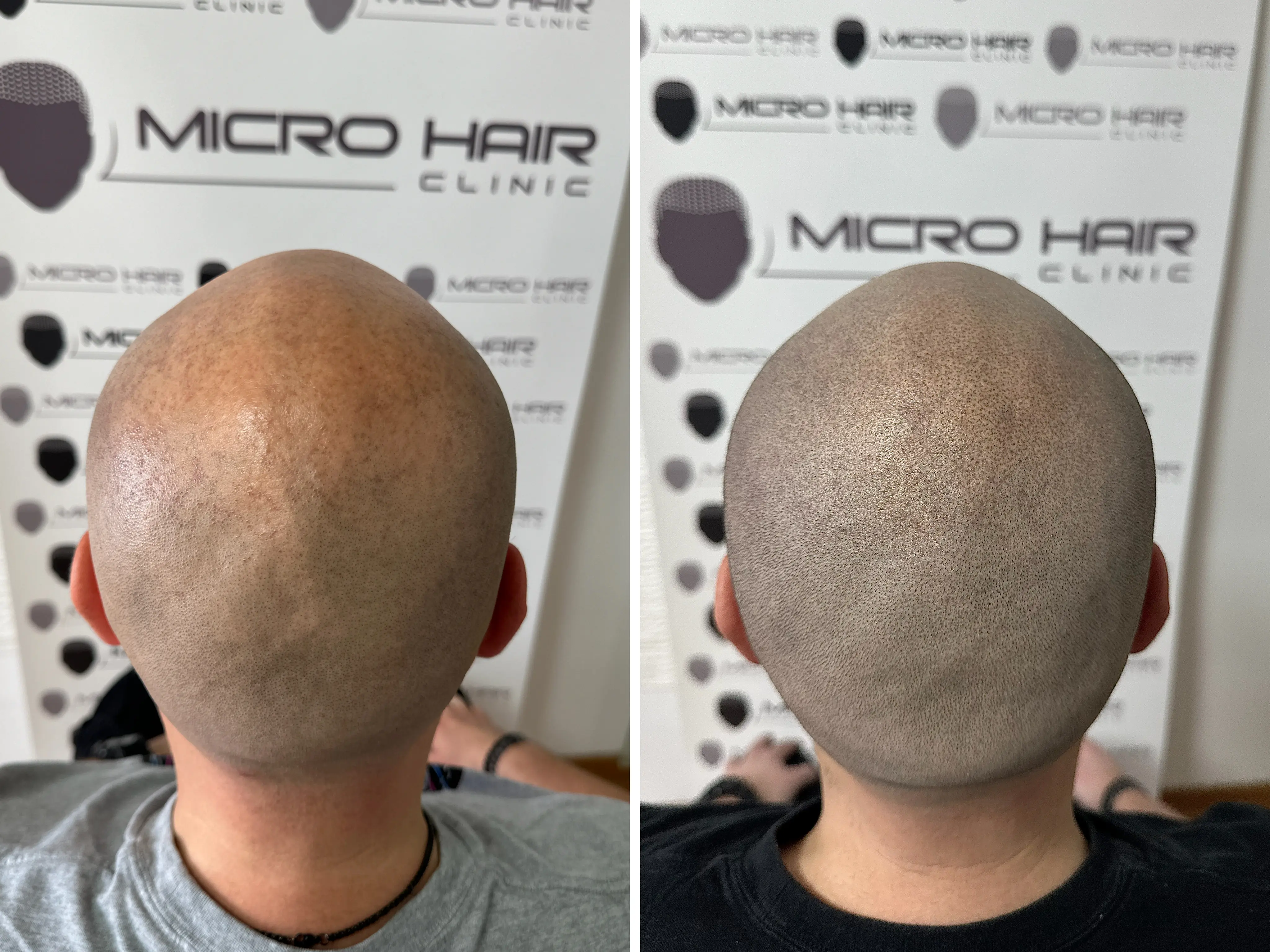 SMP rezultat pred in po - tretman mikropigmentacije 6